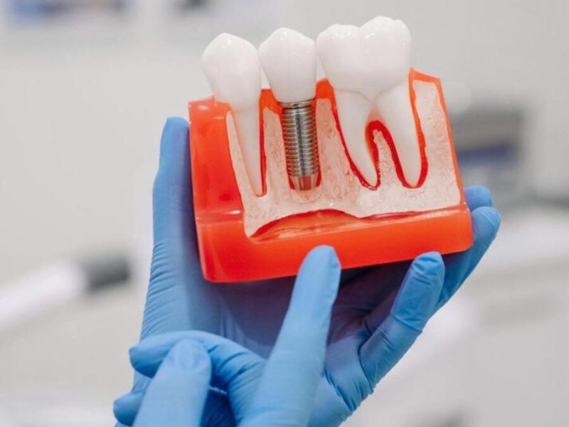 Implantes Dentários: Guia Completo com o IOA Joinville